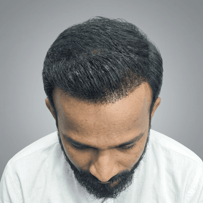 Before hair restoration treatment