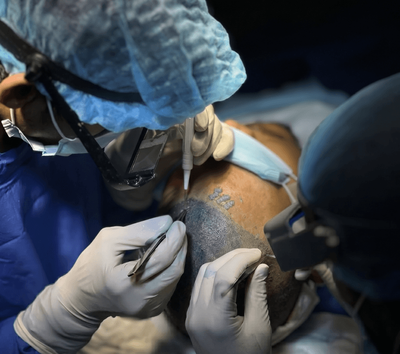 Hair restoration procedure