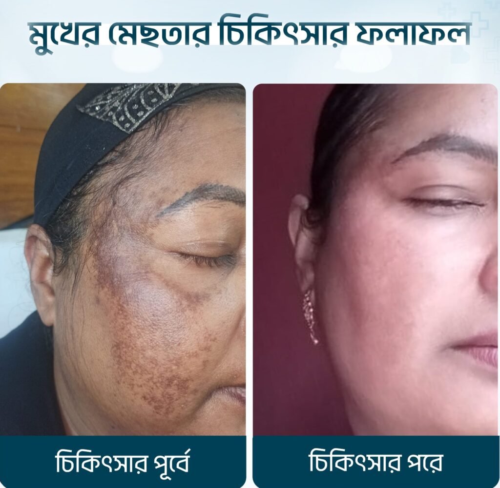 Best Skin Treatment in chittagong